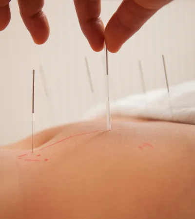 Acupuncture in Hyderabad