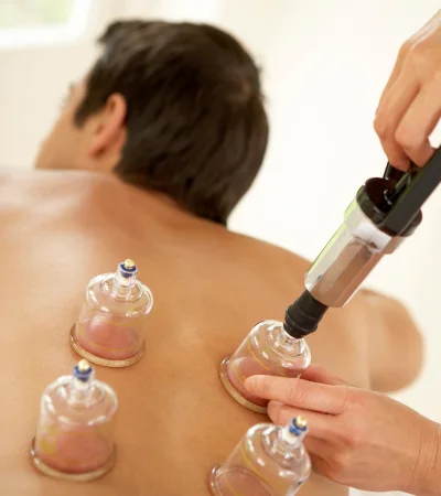 Cupping therapy in Hyderabad for back pain relief