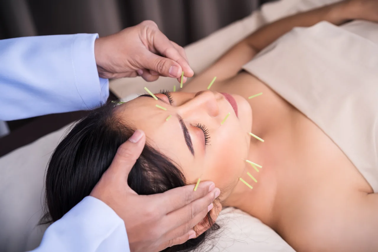 Facial acupuncture in Hyderabad for stress relief