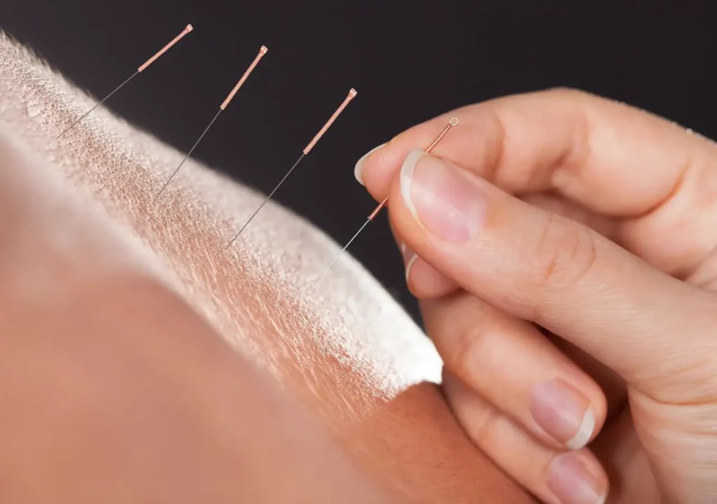 Modern Acupuncture In Hyderabad